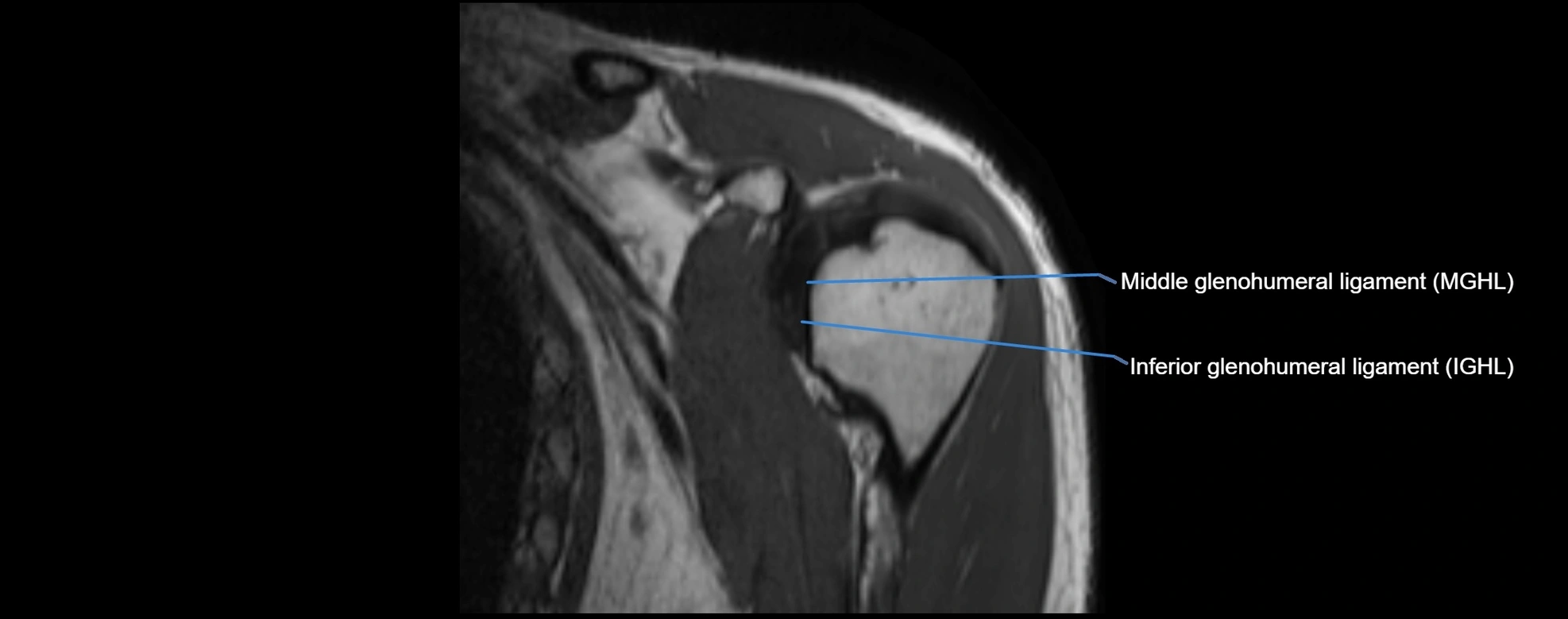 shoulder ligments coronal  cross sectional anatomy 3T MRI AI enhanced radiology image -img-00001-00010.webp